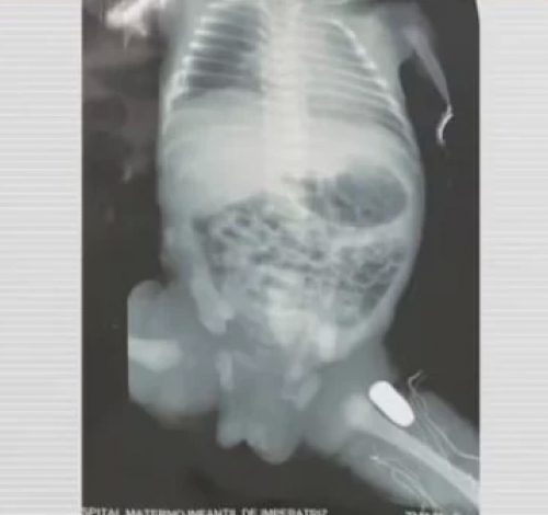 Adolescente grávida é baleada, e parto de urgência é realizado; bebê foi ferido na perna